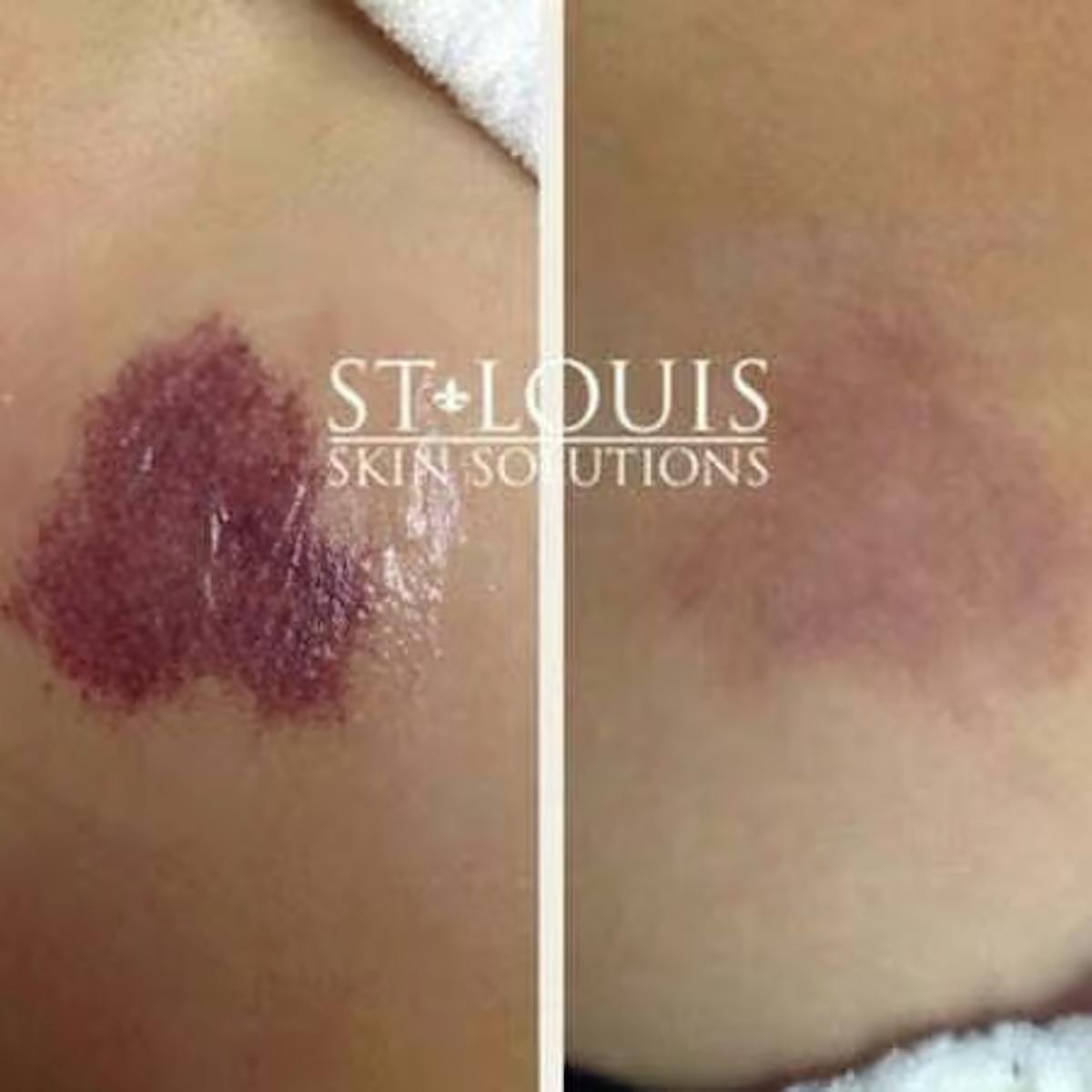 Laser Treatments Before & After Gallery - Patient 390846 - Image 1