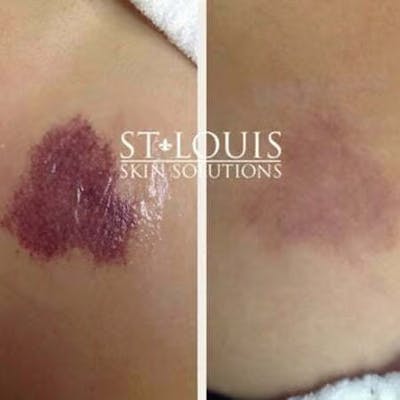 Laser Treatments Before & After Gallery - Patient 390846 - Image 1