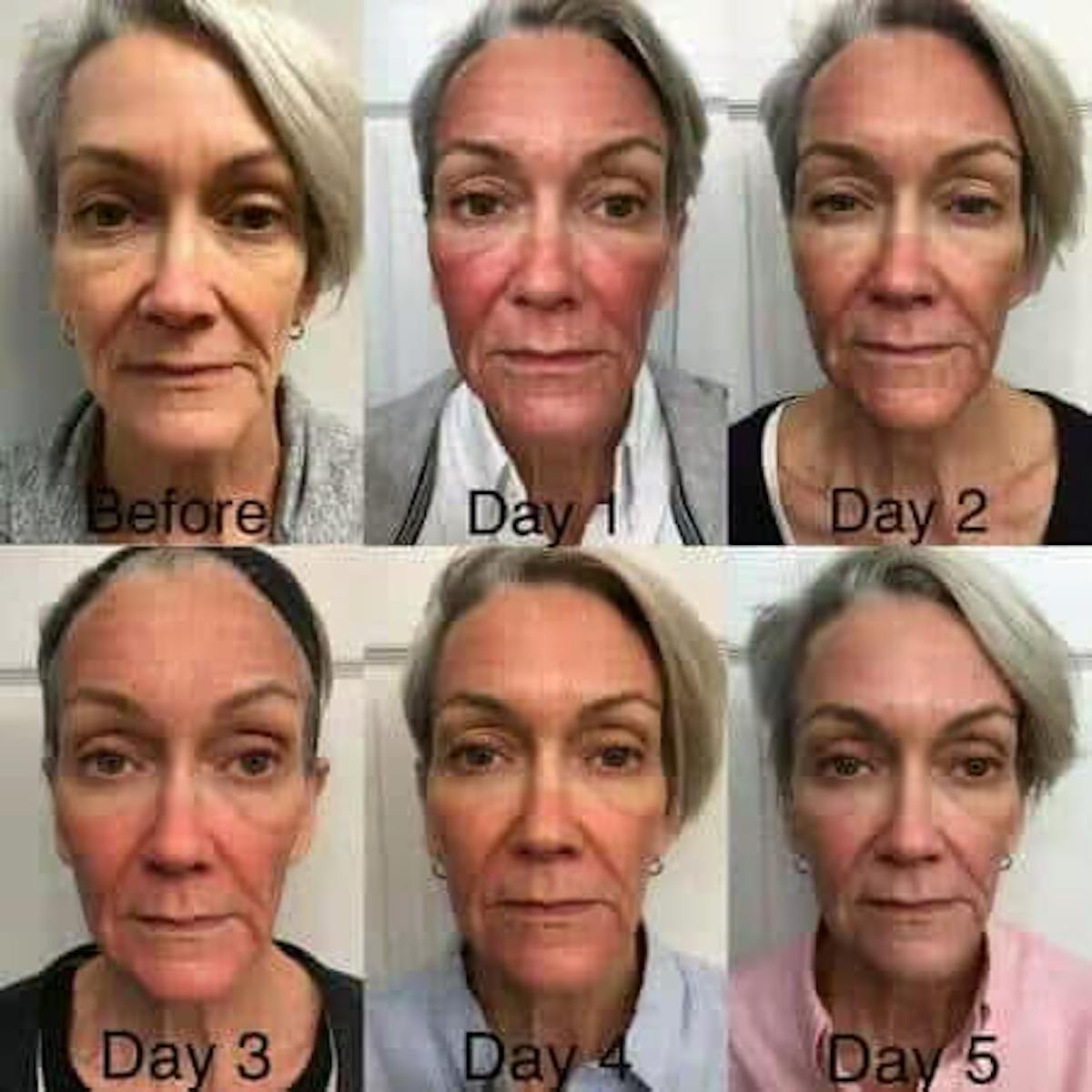 Laser Treatments Before & After Gallery - Patient 199992 - Image 1
