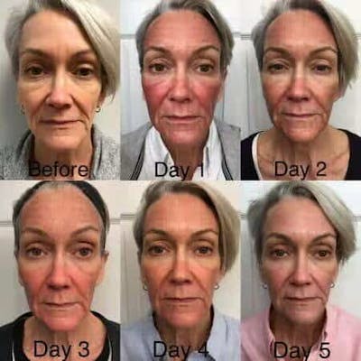 Laser Treatments Before & After Gallery - Patient 199992 - Image 1
