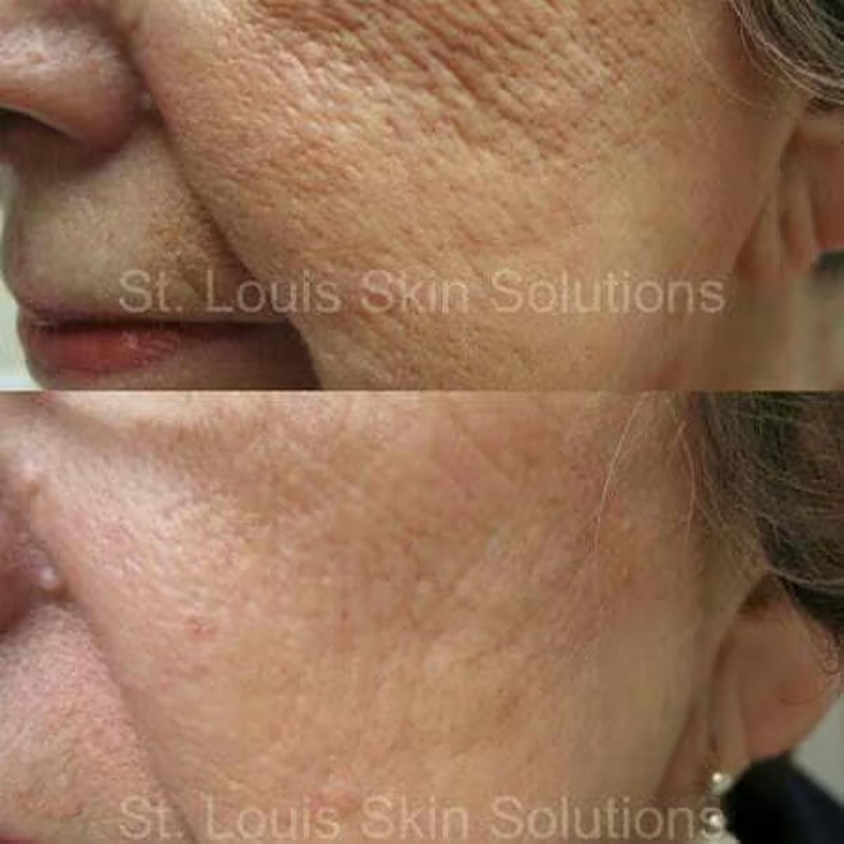 Laser Treatments Before & After Gallery - Patient 129563 - Image 1