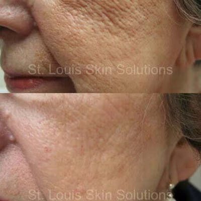 Laser Treatments Before & After Gallery - Patient 129563 - Image 1