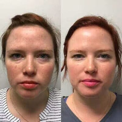 Laser Treatments Before & After Gallery - Patient 338923 - Image 1