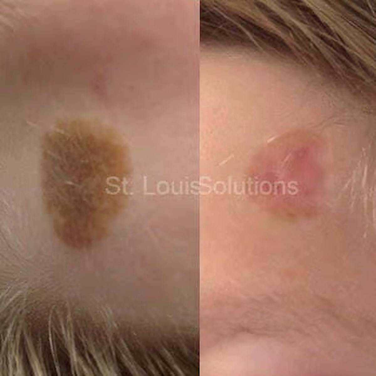 Laser Treatments Before & After Gallery - Patient 317012 - Image 1