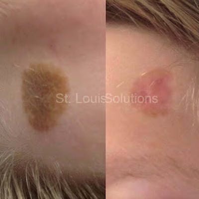 Laser Treatments Before & After Gallery - Patient 317012 - Image 1