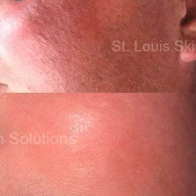 Laser Treatments Before & After Gallery - Patient 133252 - Image 1