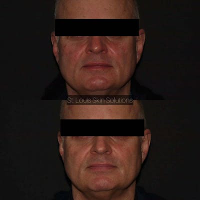 Laser Treatments Before & After Gallery - Patient 253347 - Image 1