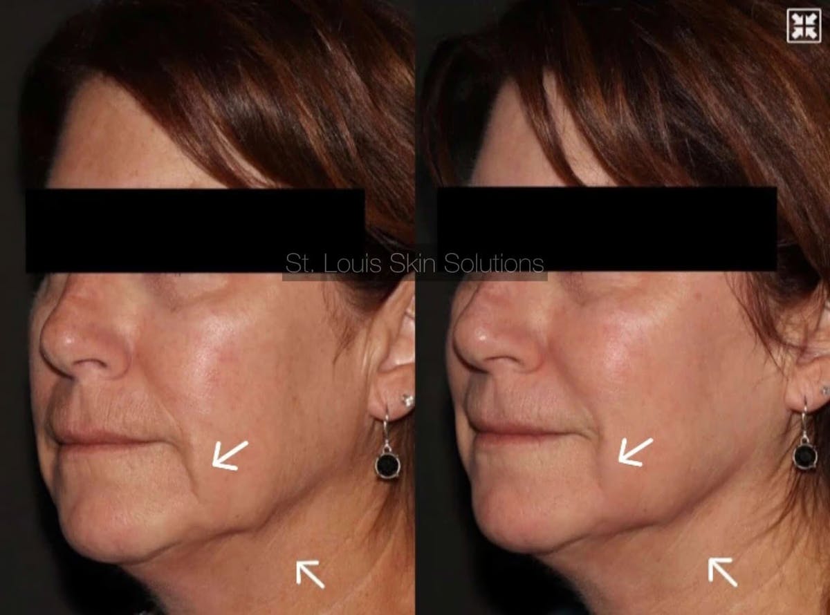 Laser Treatments Before & After Gallery - Patient 239510 - Image 1