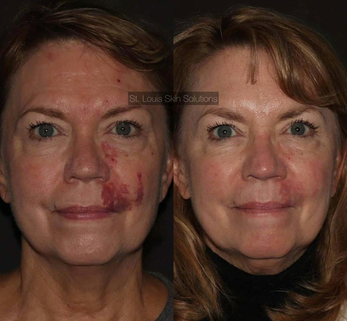 Laser Treatments Before & After Gallery - Patient 201276 - Image 1