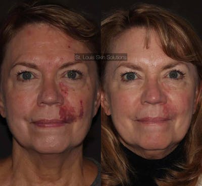 Laser Treatments Before & After Gallery - Patient 201276 - Image 1