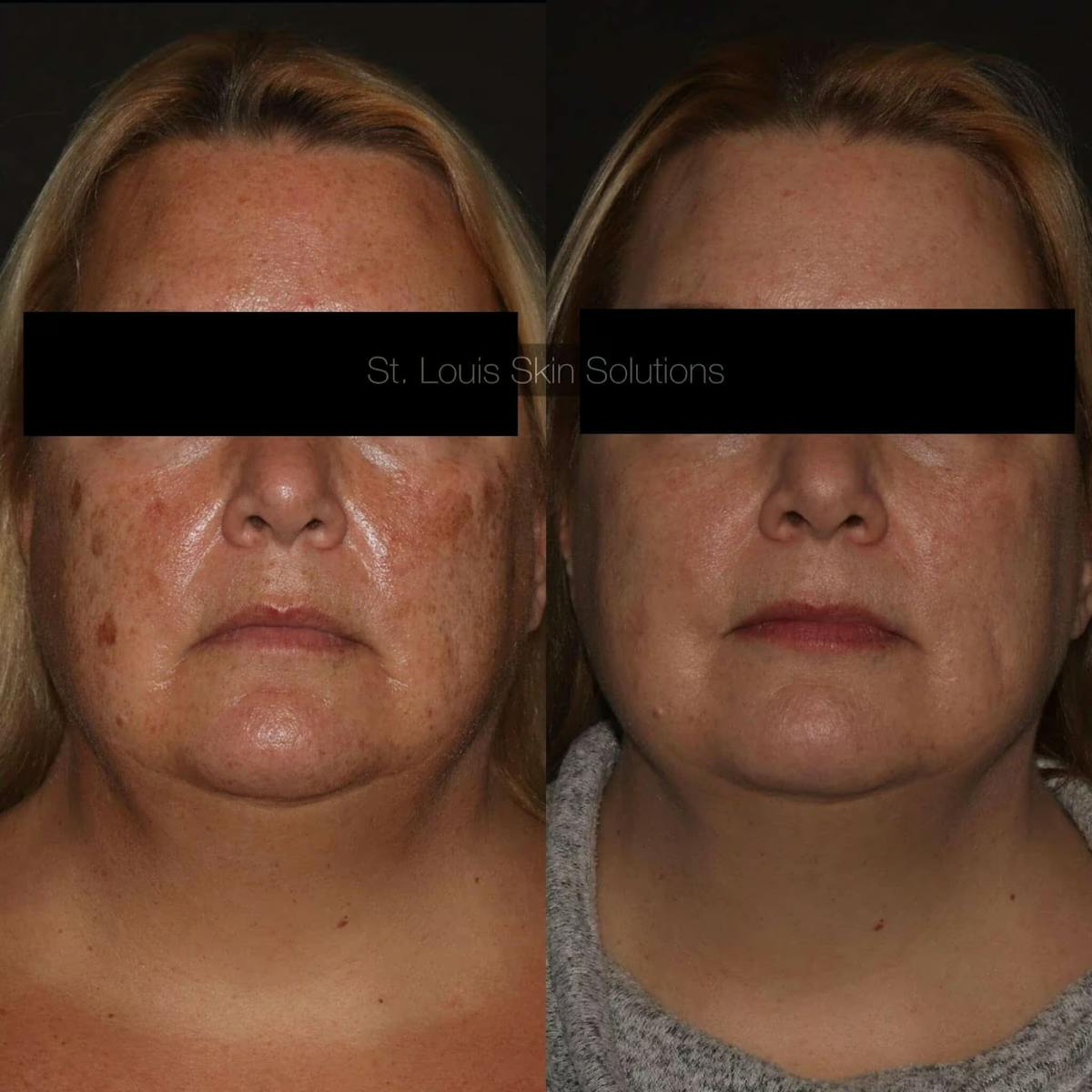 Laser Treatments Before & After Gallery - Patient 257908 - Image 1