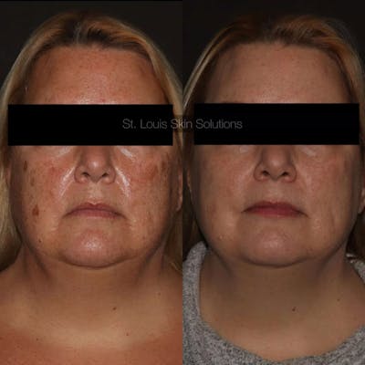 Laser Treatments Before & After Gallery - Patient 257908 - Image 1