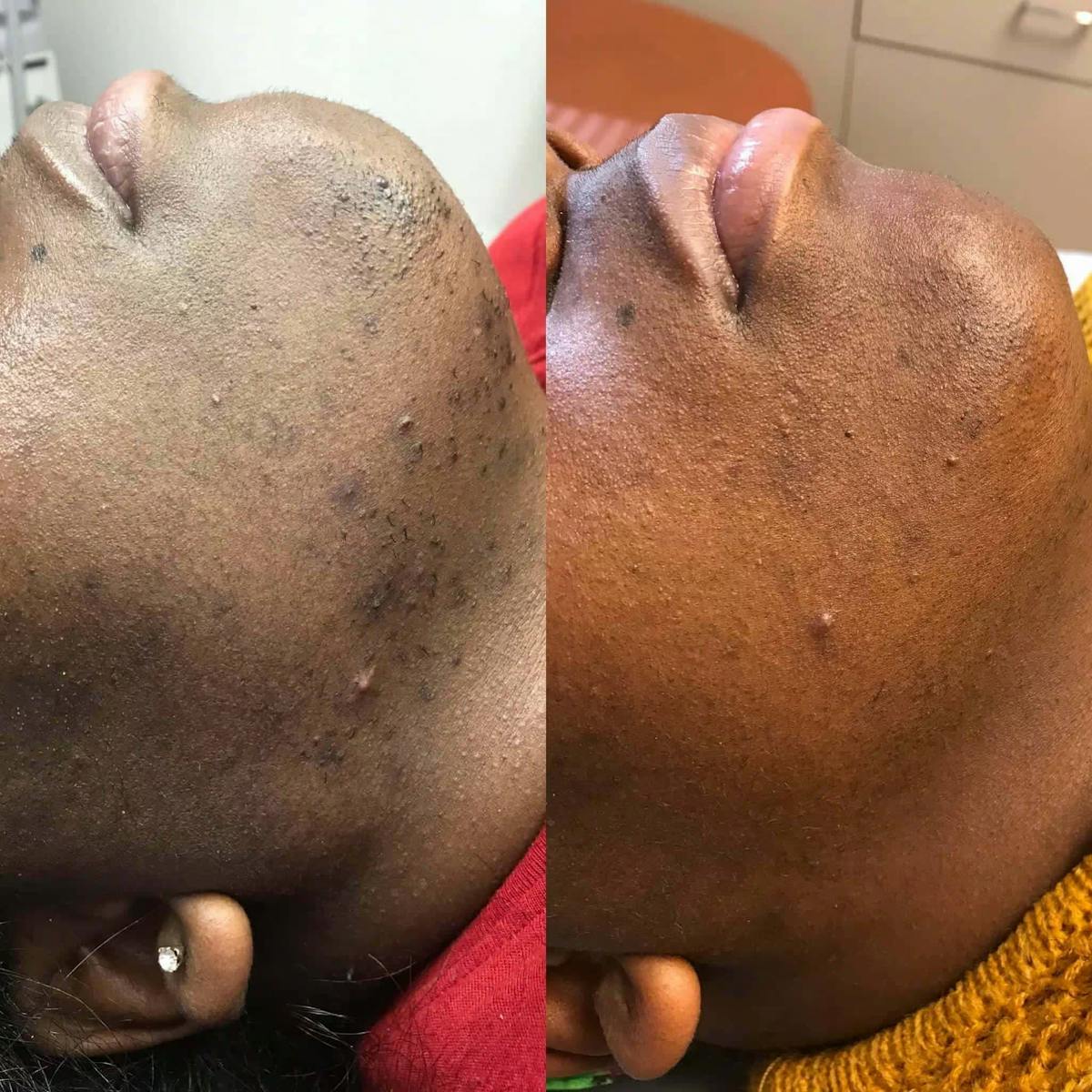 Laser Hair Reduction Before & After Gallery - Patient 298120 - Image 1