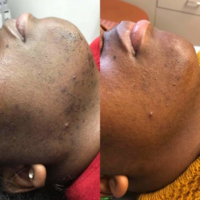 Laser Hair Reduction Before & After Gallery - Patient 298120 - Image 1