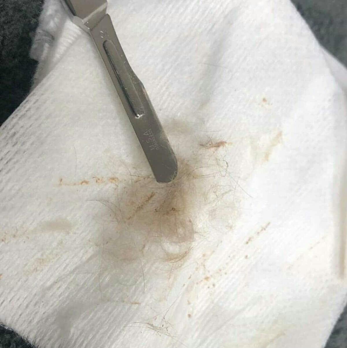 Laser Hair Reduction Before & After Gallery - Patient 171672 - Image 1
