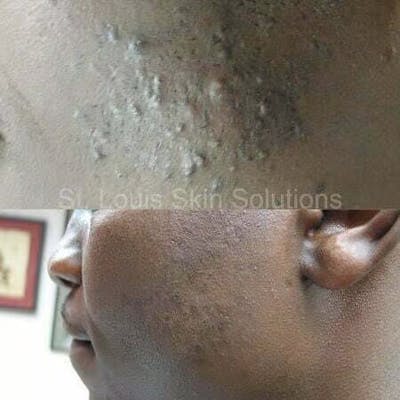 Laser Hair Reduction Before & After Gallery - Patient 149237 - Image 1