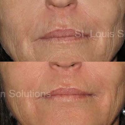 Radio Frequency Treatments Before & After Gallery - Patient 288379 - Image 1