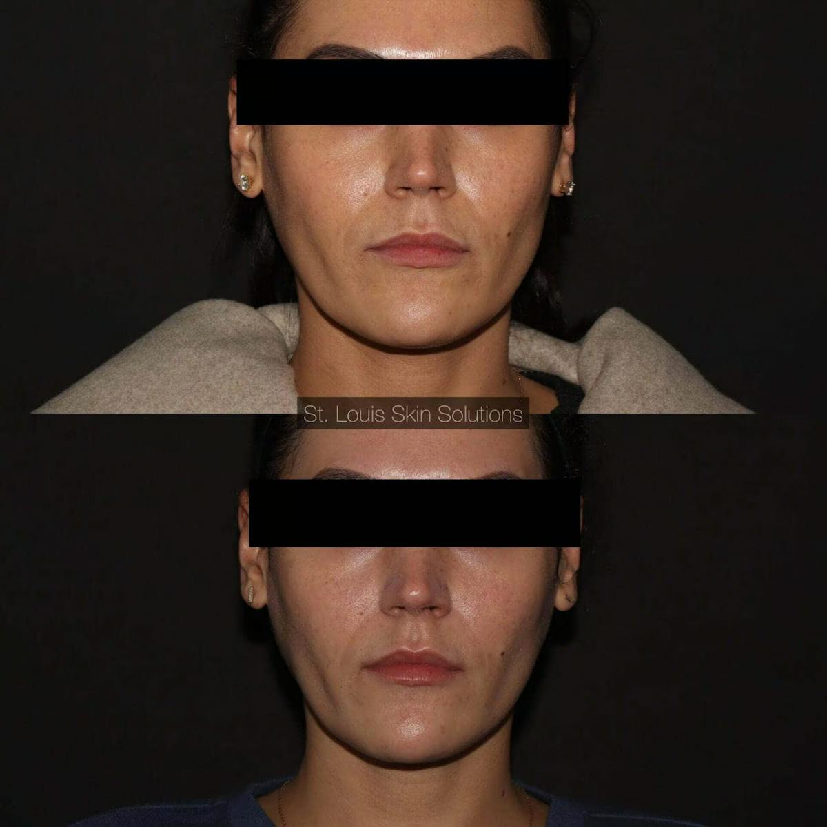 Neurotoxins Before & After Gallery - Patient 394796 - Image 1