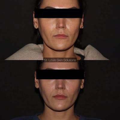 Neurotoxins Before & After Gallery - Patient 394796 - Image 1