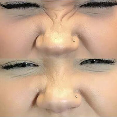 Neurotoxins Before & After Gallery - Patient 312520 - Image 1