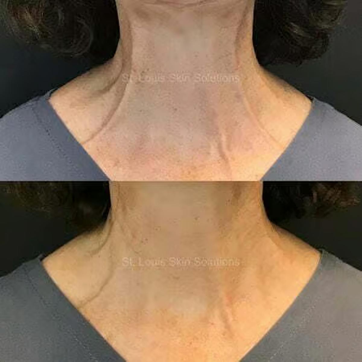 Neurotoxins Before & After Gallery - Patient 810910 - Image 1