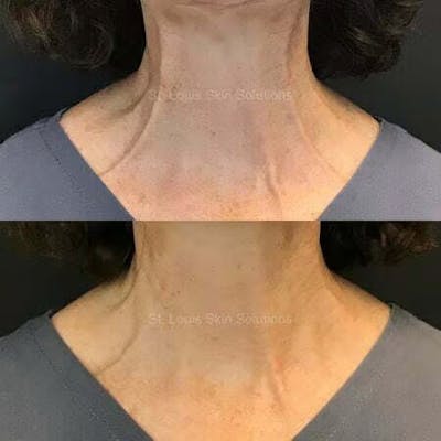 Neurotoxins Before & After Gallery - Patient 810910 - Image 1