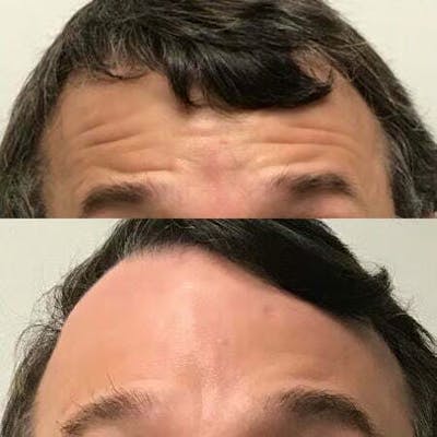 Neurotoxins Before & After Gallery - Patient 337709 - Image 1