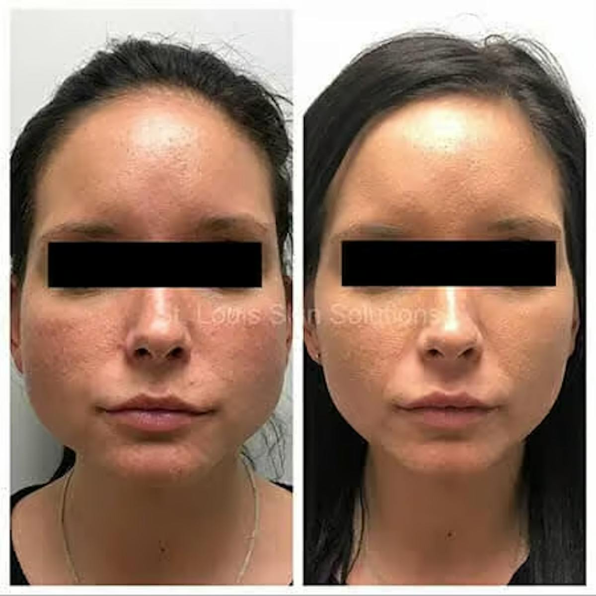 Neurotoxins Before & After Gallery - Patient 236975 - Image 1