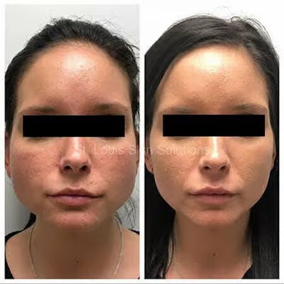Neurotoxins Before & After Gallery - Patient 236975 - Image 1