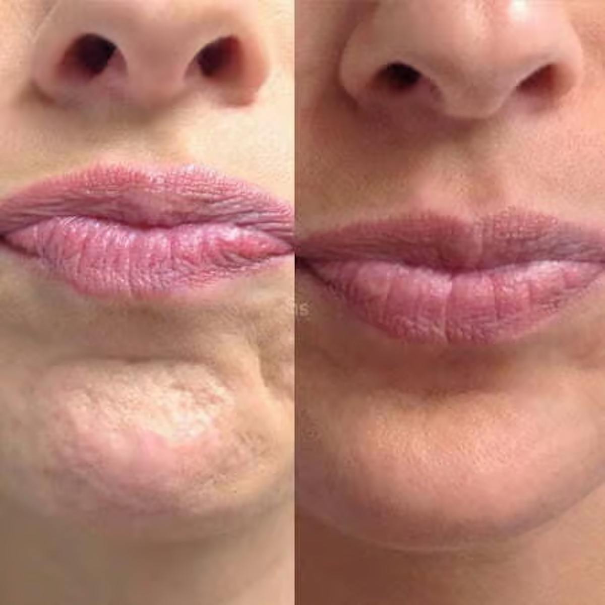 Neurotoxins Before & After Gallery - Patient 242390 - Image 1