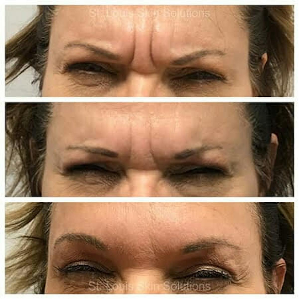 Neurotoxins Before & After Gallery - Patient 309138 - Image 1