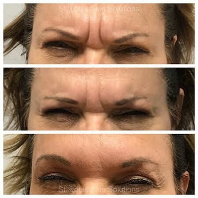 Neurotoxins Before & After Gallery - Patient 309138 - Image 1