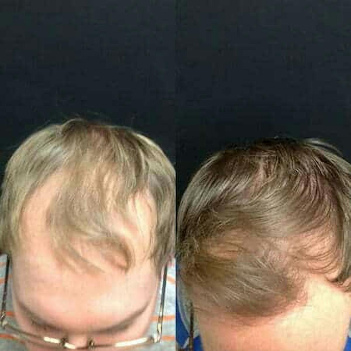Hair Loss Before & After Gallery - Patient 167183 - Image 1