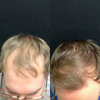 Hair Loss Before & After Gallery - Patient 167183 - Image 1