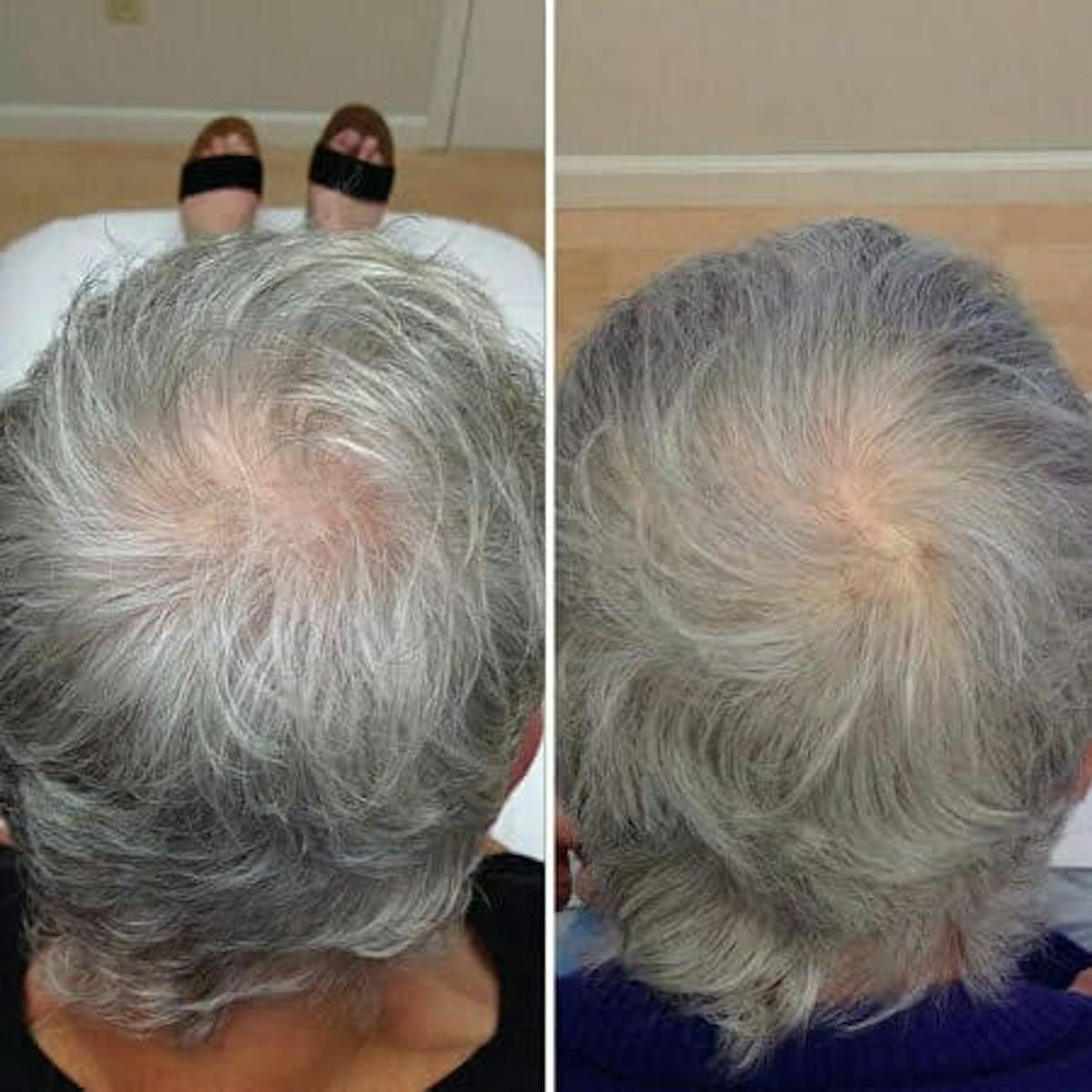Hair Loss Before & After Gallery - Patient 388455 - Image 1