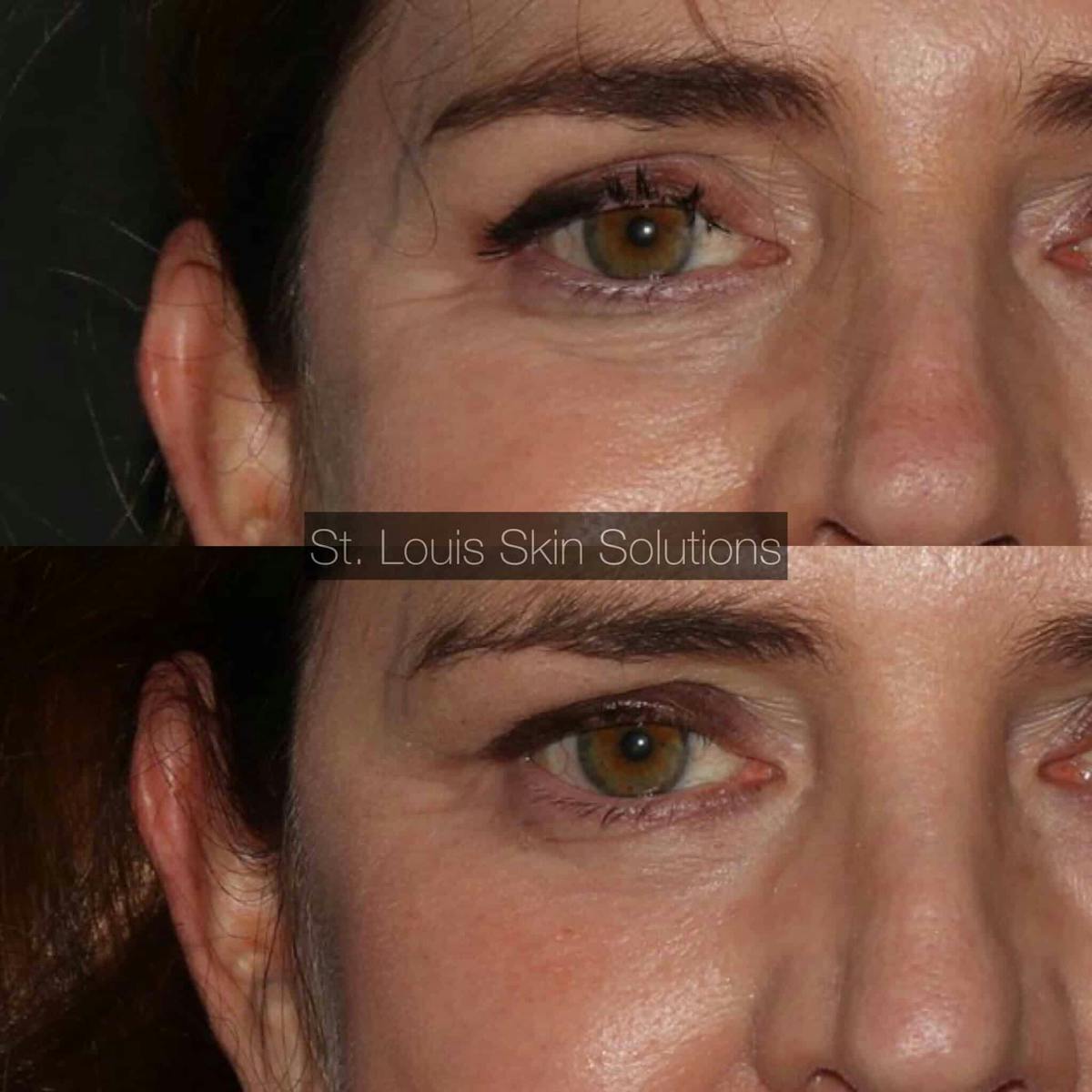 Plasma Pen Before & After Gallery - Patient 160406 - Image 1