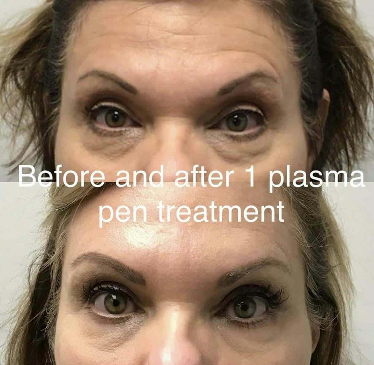 Plasma Pen Before & After Gallery - Patient 176740 - Image 1