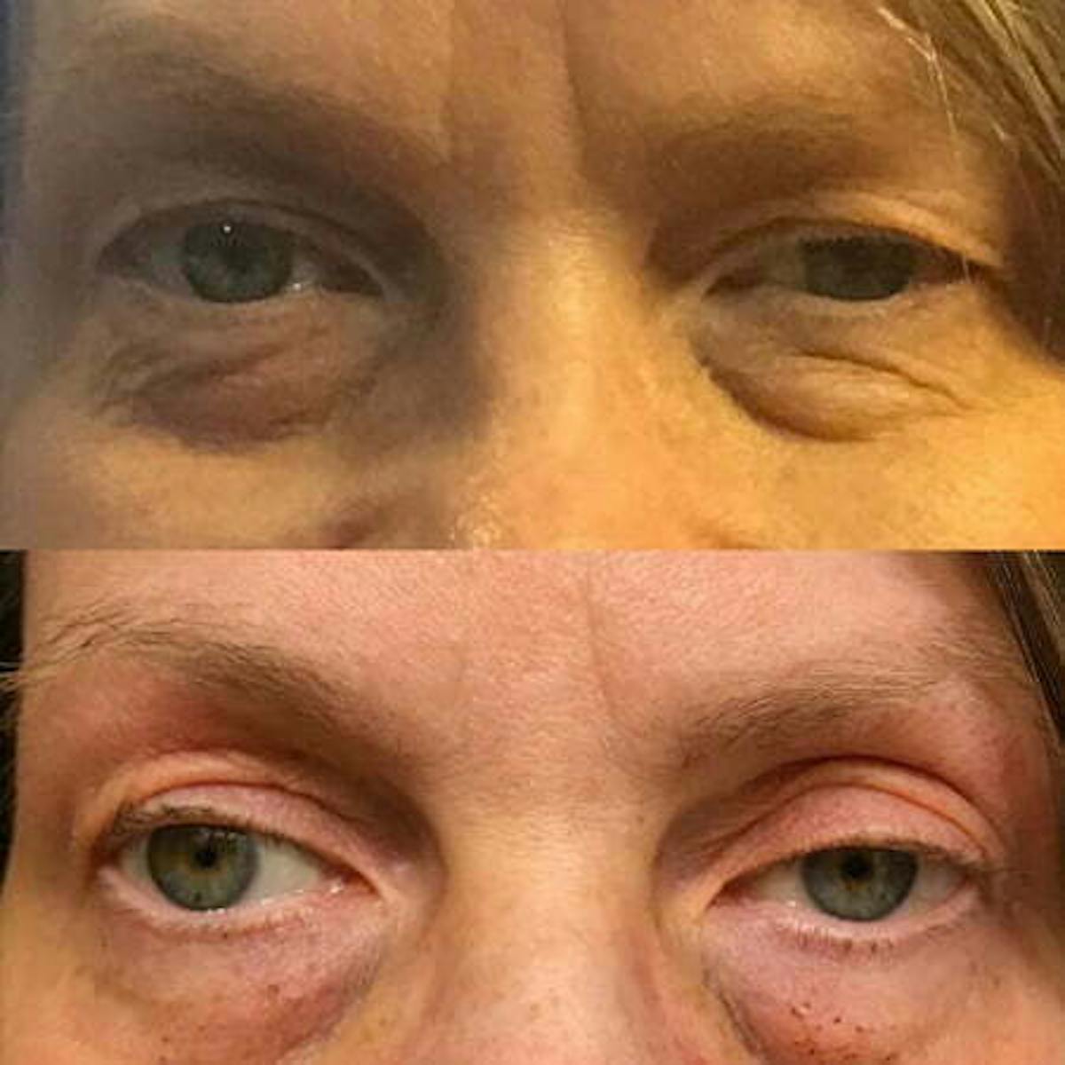 Plasma Pen Before & After Gallery - Patient 978501 - Image 1