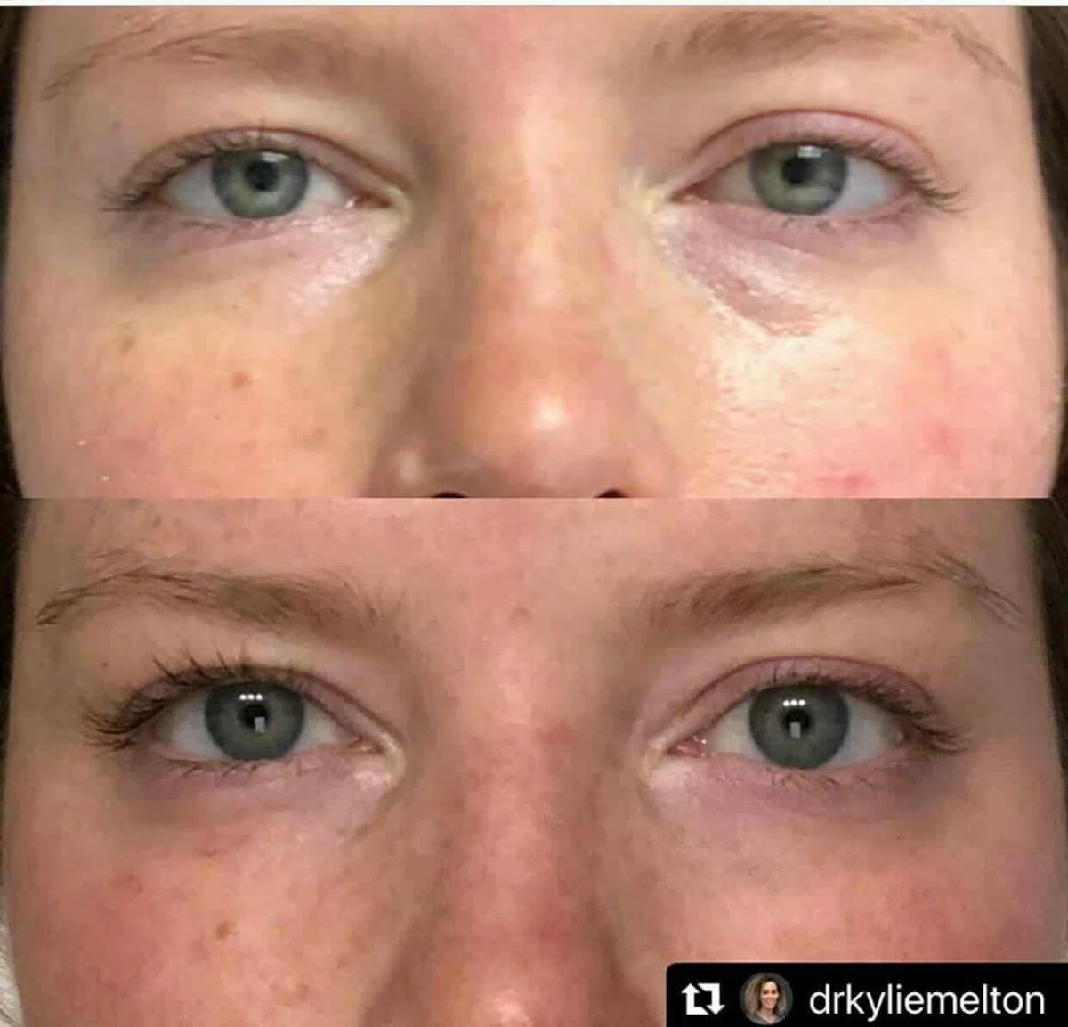 Plasma Pen Before & After Gallery - Patient 492730 - Image 1