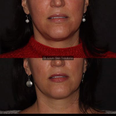 Non-Surgical Fat Reduction Before & After Gallery - Patient 234550 - Image 1