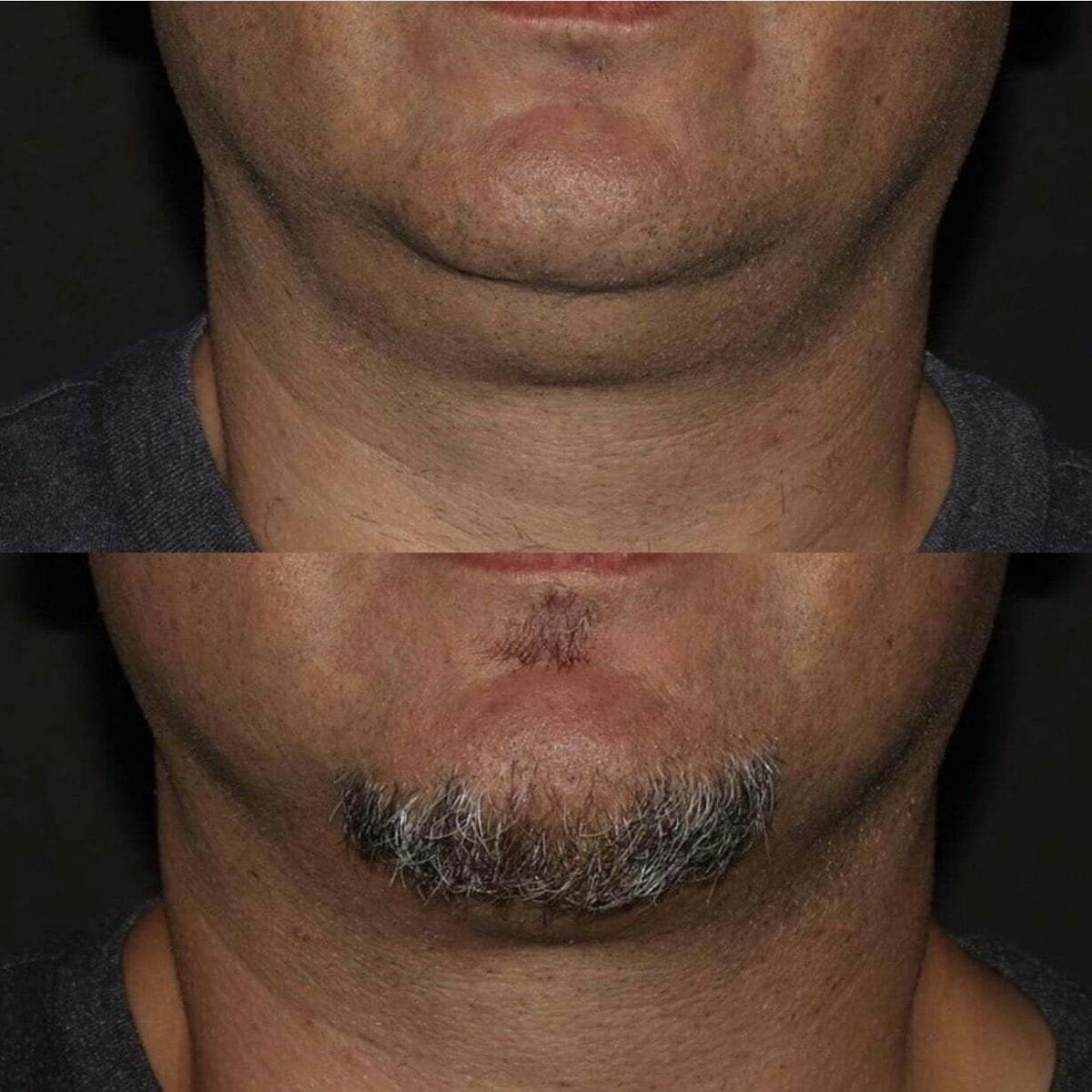 Non-Surgical Fat Reduction Before & After Gallery - Patient 818756 - Image 1