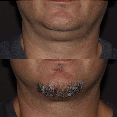 Non-Surgical Fat Reduction Before & After Gallery - Patient 818756 - Image 1