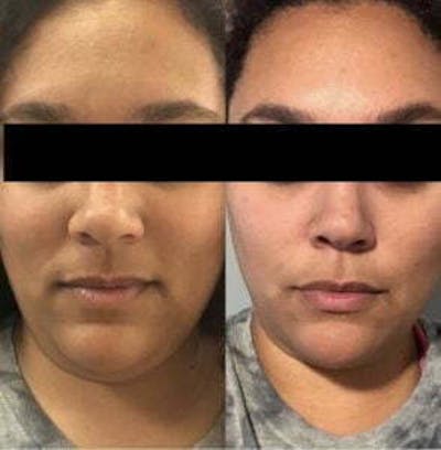 Non-Surgical Fat Reduction Before & After Gallery - Patient 172807 - Image 1