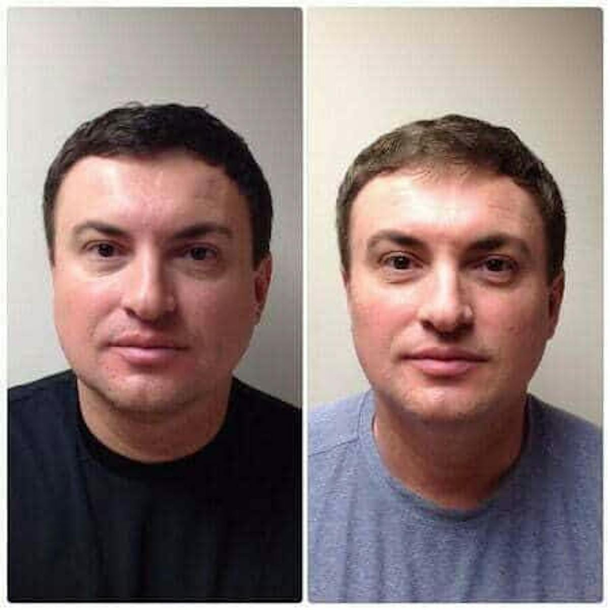 Non-Surgical Fat Reduction Before & After Gallery - Patient 155913 - Image 1
