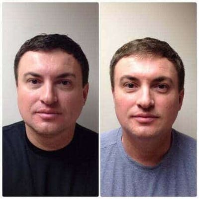 Non-Surgical Fat Reduction Before & After Gallery - Patient 155913 - Image 1
