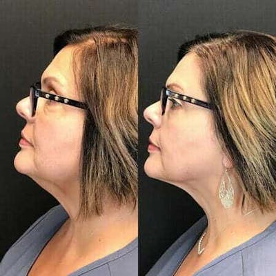 Non-Surgical Fat Reduction Before & After Gallery - Patient 234523 - Image 1