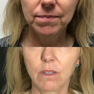 Non-Surgical Fat Reduction Before & After Gallery - Patient 192693 - Image 1