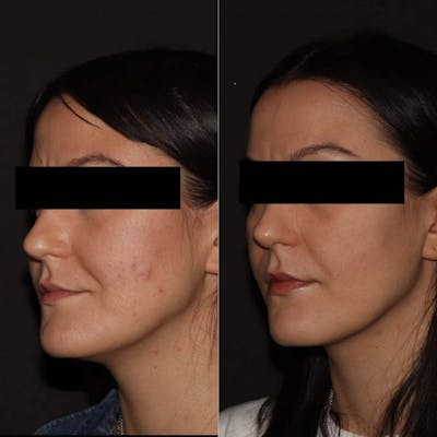Chemical Peels Before & After Gallery - Patient 942776 - Image 1