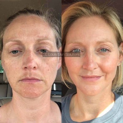 Chemical Peels Before & After Gallery - Patient 158236 - Image 1
