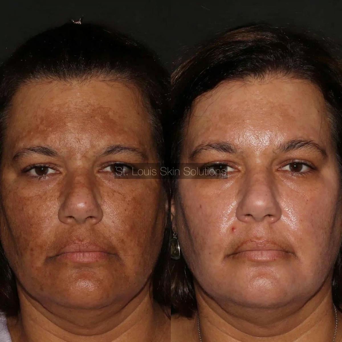 Chemical Peels Before & After Gallery - Patient 143733 - Image 1